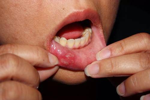 herpes-on-mouth-4.jpg